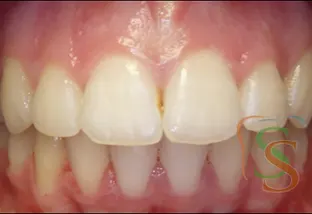 Denti allineati vista frontale e Cubo di Rubik