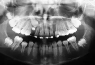 Scopri di più sull'articolo Odontoma